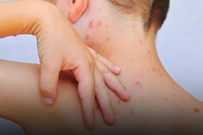 Vírus do sarampo está ativo em 29 municípios paranaenses